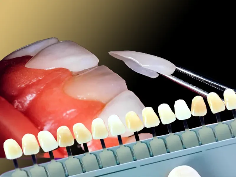 لمینت دندان در سعادت آباد