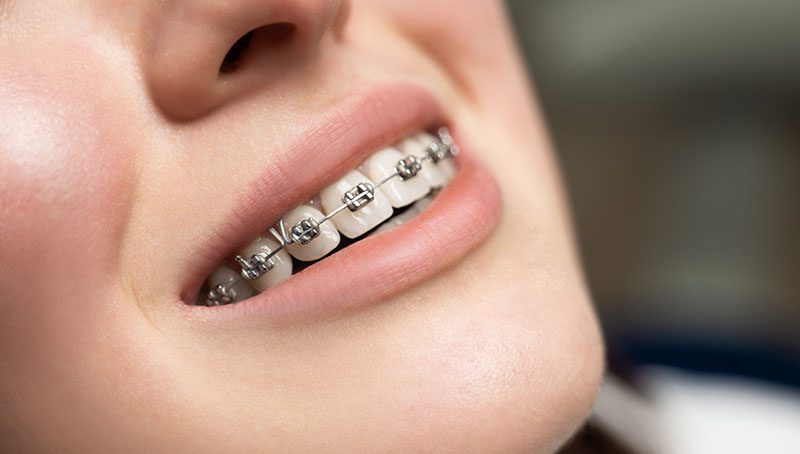 انواع-اورتودنسی