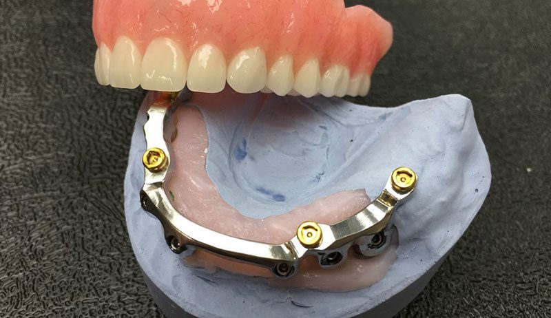 مزایای-اوردنچر-دندان-یا-دندان-مصنوعی-با-پایه-ایمپلنت