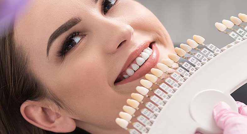 مزایای-لومینیرز-دندان