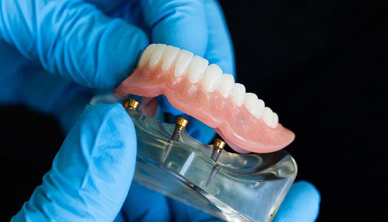 مشاوره-فوری-تخصصی-اوردنچر-دندان