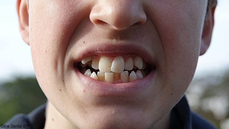 کرادینگ دندان