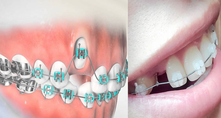 اکسپوژر دندان