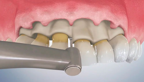 اکسپوژر دندان