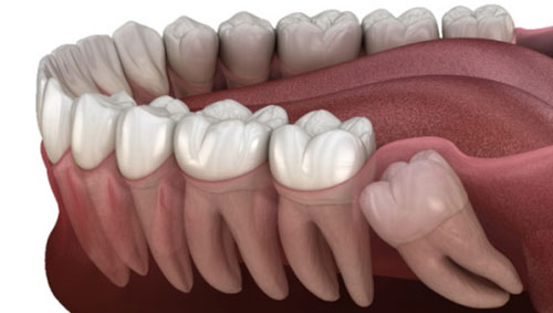 اکسپوژر دندان