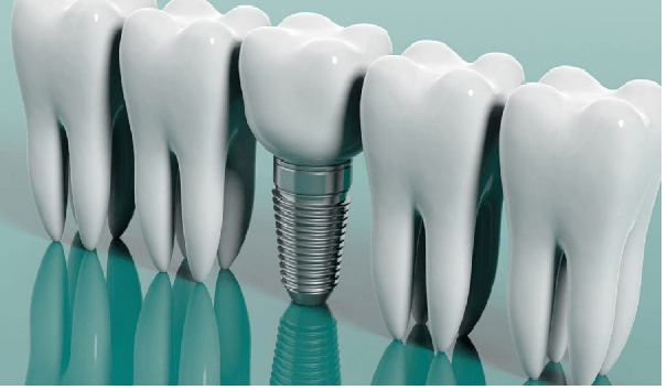 تاج گذاشتن روی دندان