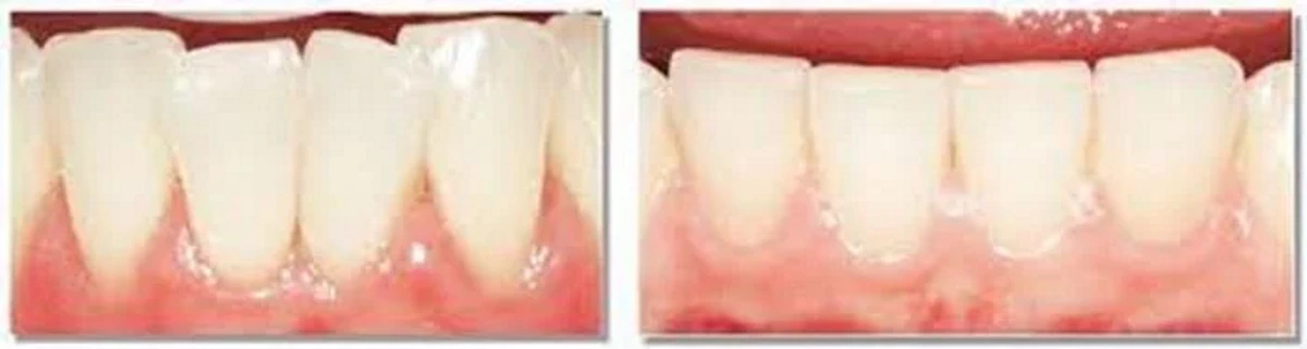 استریپ دندان