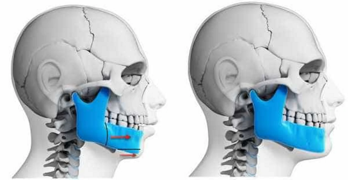 جراحی ارتوگناتیک