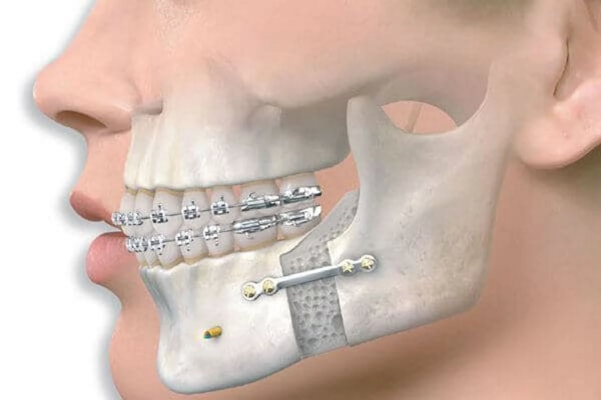 جراحی ارتوگناتیک