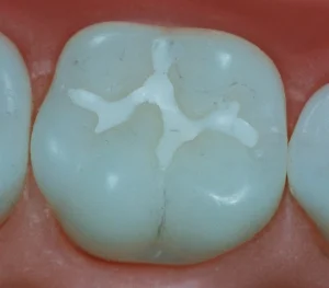 فیشورسیلانت تراپی