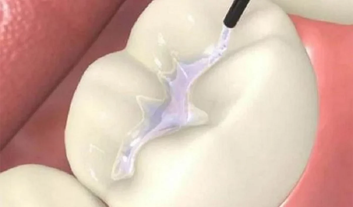 فیشورسیلانت تراپی