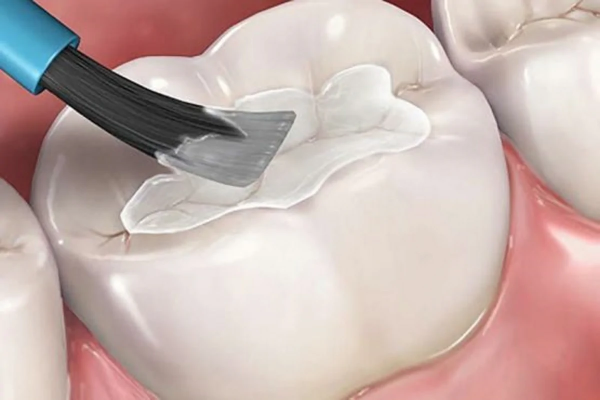 فیشورسیلانت تراپی