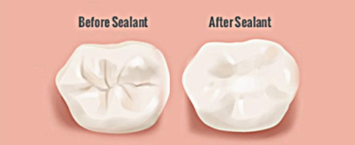 فیشورسیلانت تراپی