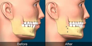 مراقبت از جراحی فک