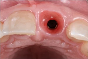 هیلینگ ایمپلنت