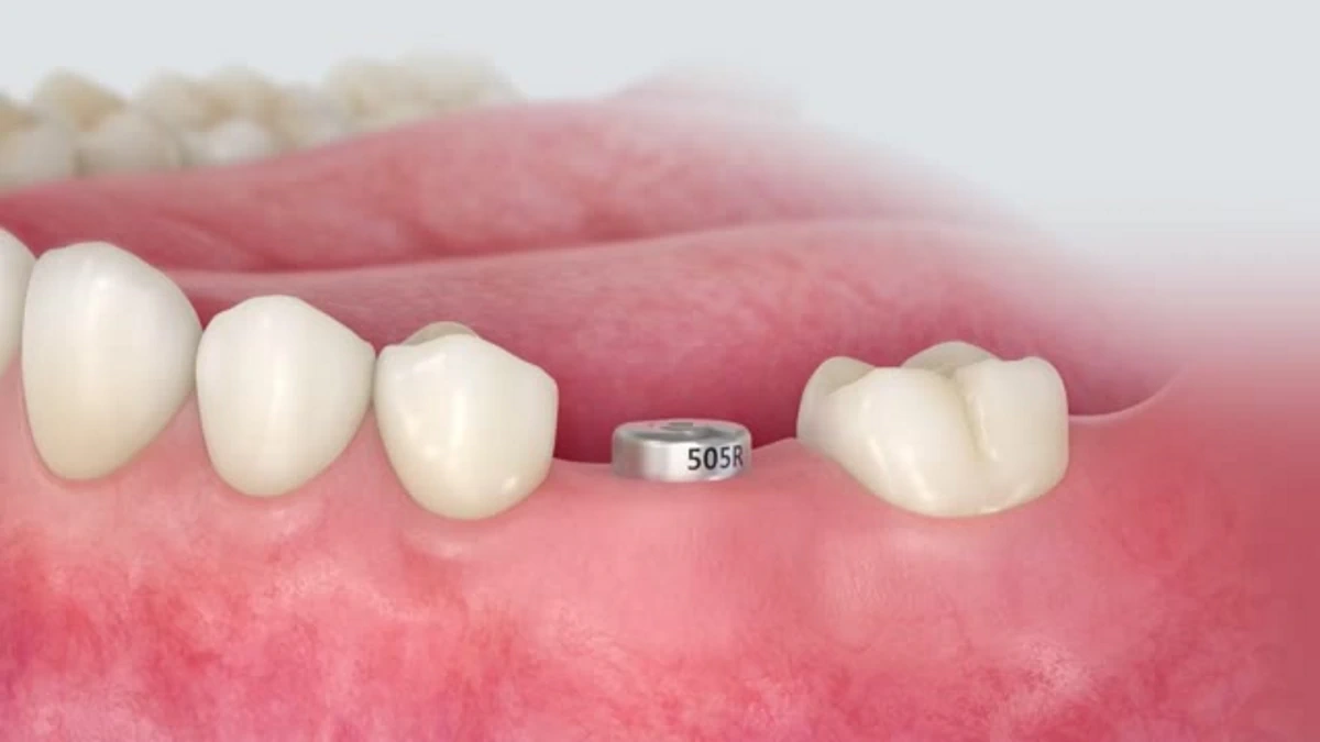 هیلینگ ایمپلنت