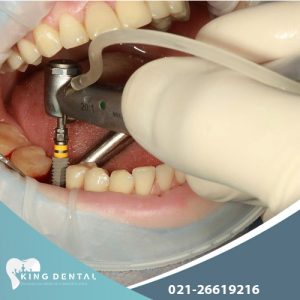 ایملپنت اشترومن چیست؟