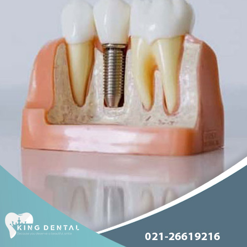 ایمپلنت اشترومن