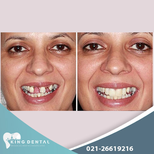 ایمپلنت دندان جلو در غرب تهران - کینگ دنتال