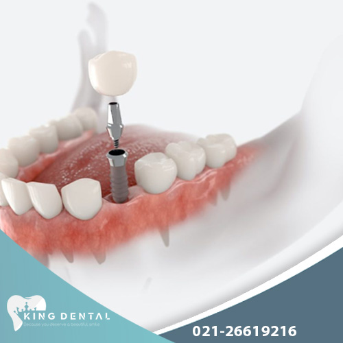 ایمپلنت دیجیتال در سعادت آباد