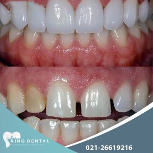 بررسی تفاوت های لمینت و کامپوزیت