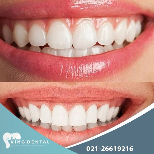 تفاوت های لمینت و کامپوزیت دندان