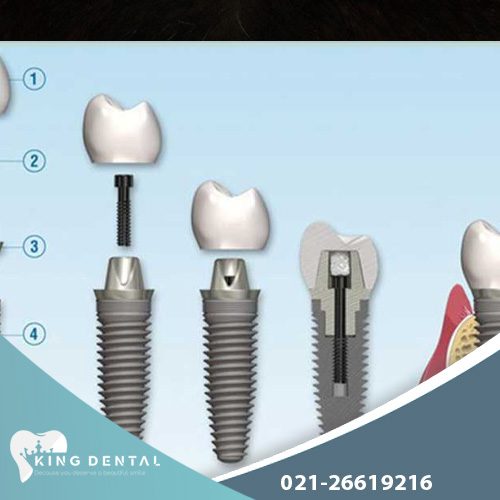 ایمپلنت کره ای دندان