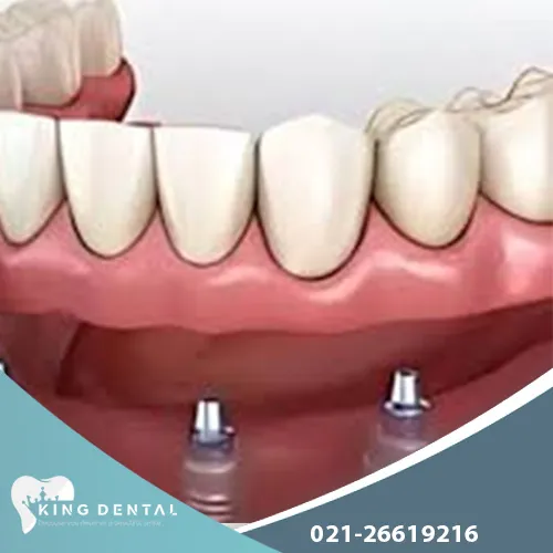 هزینه ایمپلنت متحرک