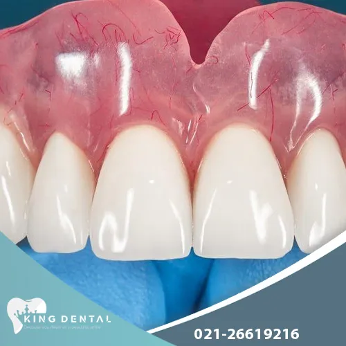 ایمپلنت دندان ثابت تهران 