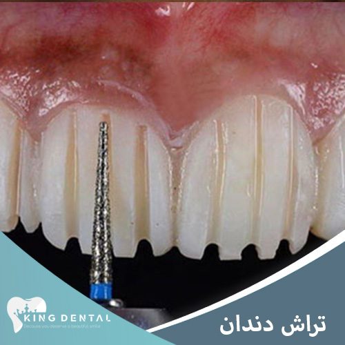 تراش دندان