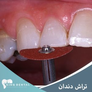تراش دندان برای کامپوزیت مهم است