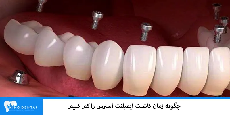 کاهش استرس و درد ایمپلنت