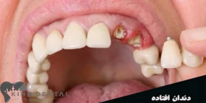 جایگزین دندان های سالم