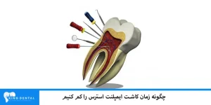 راهکار کاهش استرس و درد یمپلنت