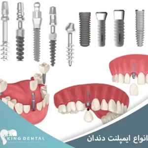 انواع ایمپلنت دندان