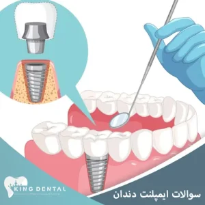 سوالات متدال در مورد ایملنت دندان