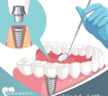 سوالات متدال در مورد ایملنت دندان