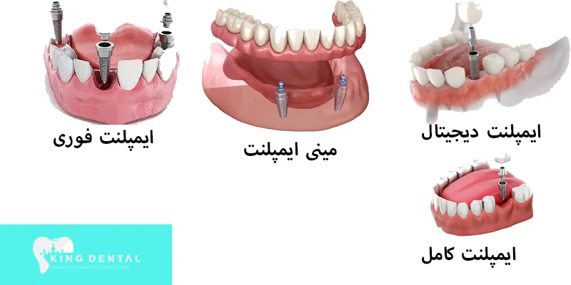 انواع ایمپلنت دندان