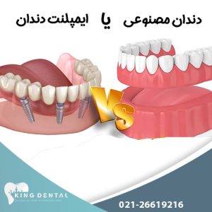 کاشت دندان یا ایمپلنت