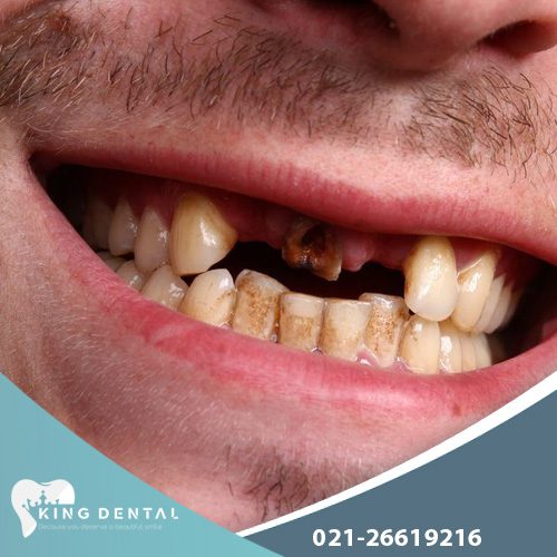 تاثیر سیگار بر ایمپلنت دندان