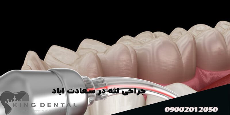 پریو لثه در سعادت اباد