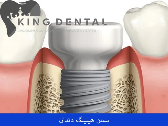 بستن هیلینگ دندان