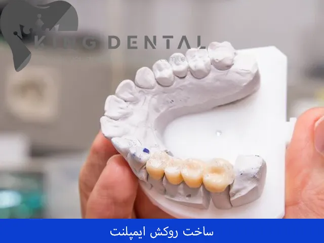 ساخت روکش ایمپلنت