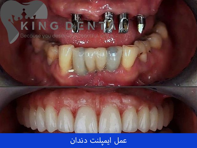 عمل ایمپلنت دندان