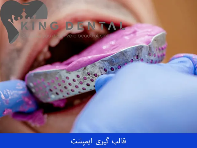 قالب گیری ایمپلنت