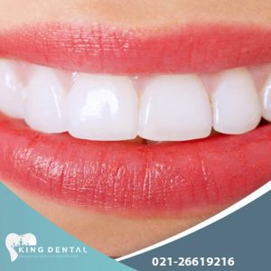 لمینت دندان چیست