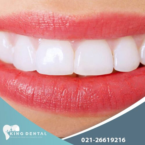 لمینت دندان چیست