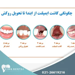 مراحل انجام ایمپلنت دندان صفر تا صد
