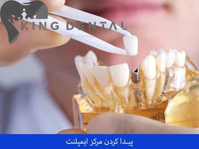 پیدا کردن مرکز ایمپلنت دندان 