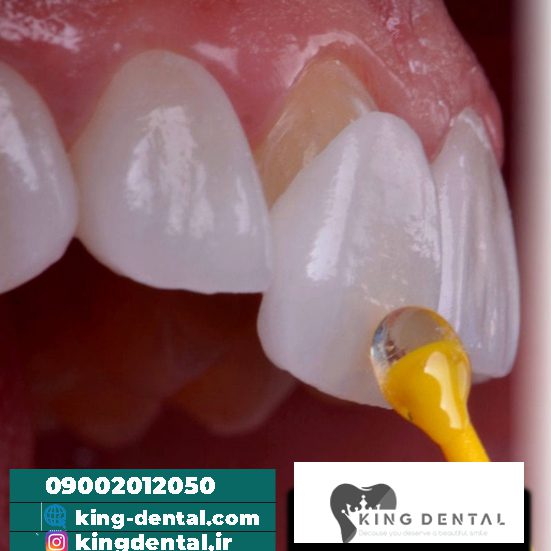 حکم لمینت دندان 